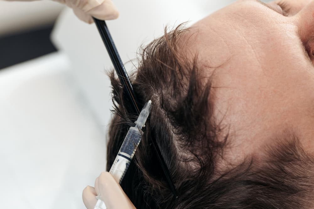 PRP Hair Treatment Cost London