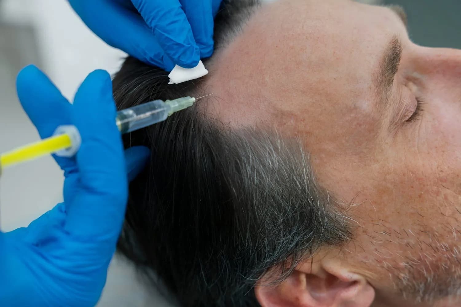 What Is Hair Mesotherapy Procedure?