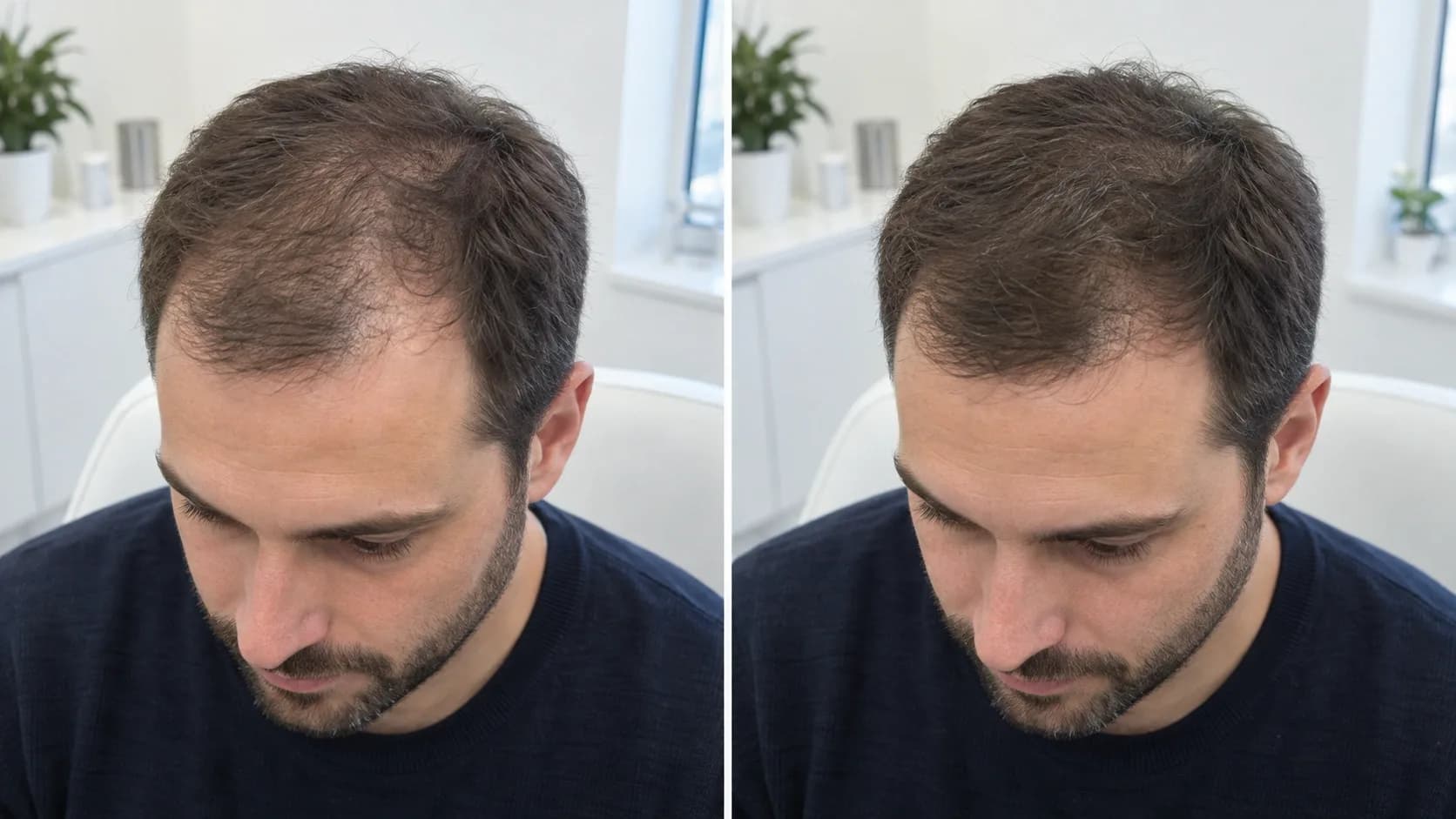 Laser Hair Therapy Before and After