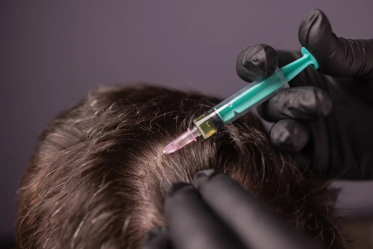 PRF for Hair Loss: How Does Platelet-Rich Fibrin Support Hair Growth?