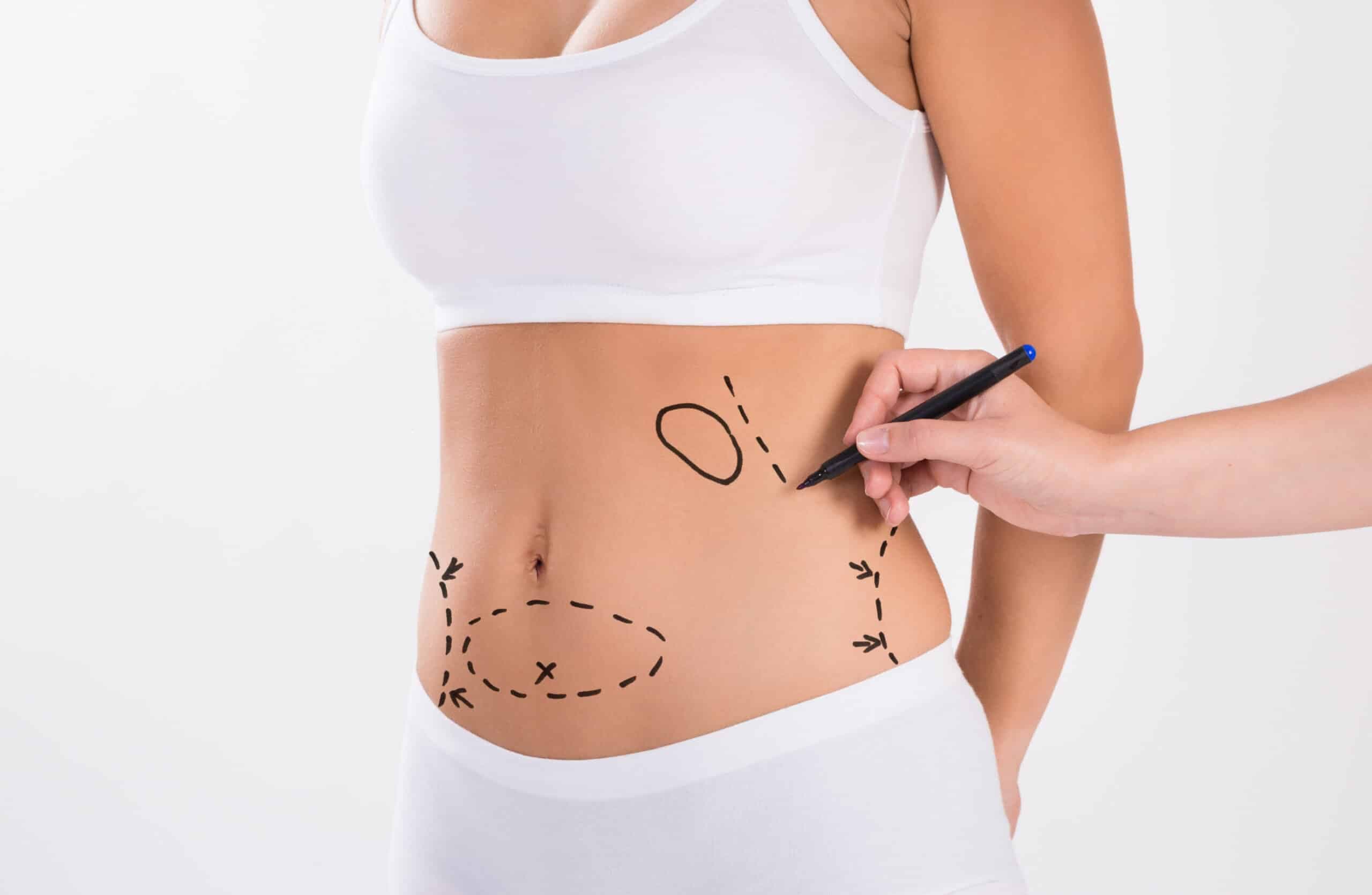 Liposuction