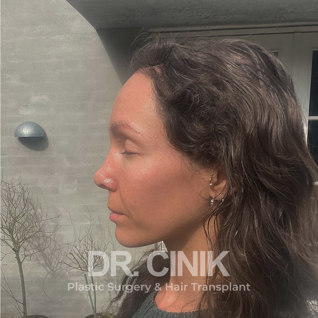 After – Hair Transplant