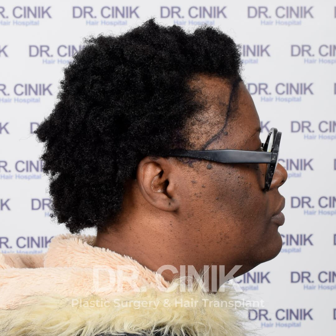 Before – Hair Transplant
