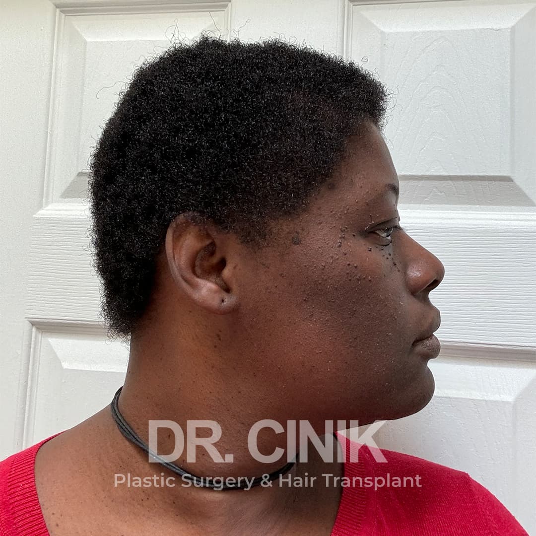 After – Hair Transplant