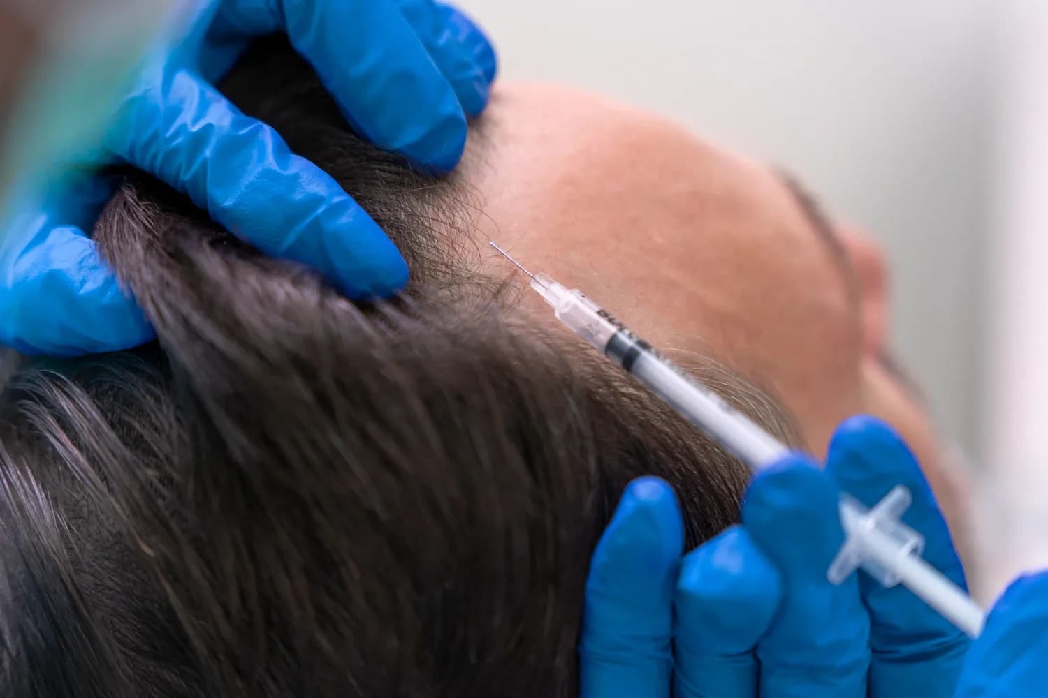 Exosome Hair Treatment Benefits